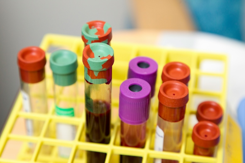 AI Study Reveals Two Types of Prostate Cancer